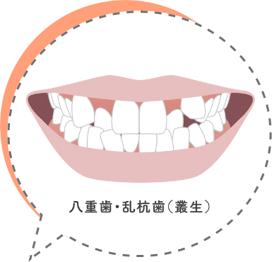 八重歯・叢生