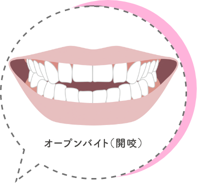 オープンバイト