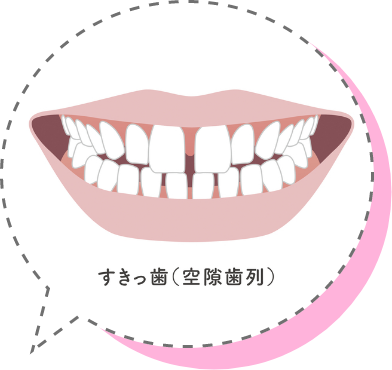 すきっ歯